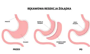 Operacja zmniejszenia żołądka na NFZ - gdzie i jak się kwalifikować