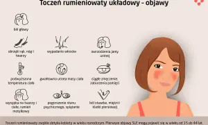 Pierwsze objawy tocznia: ból głowy, wysypka, zmęczenie, wypadanie włosów, obrzęki, gorączka, utrata wagi, owrzodzenia, problemy z pamięcią, bóle stawów.