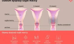Ilustracja przedstawia stadia dysplazji szyjki macicy: I, II i III stopień, z zaznaczoną tkanką uszkodzoną w III stadium. Poniżej objawy: ból, plamienia, obfite miesiączki.