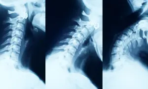 Rentgen kręgosłupa szyjnego pokazuje zmiany zwyrodnieniowe, typowe dla spondylozy. Widoczne są osteofity i zwężenia przestrzeni międzykręgowych.