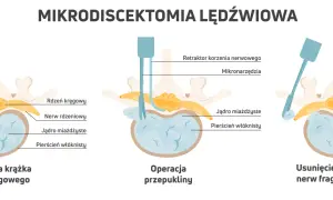 Ilustracja pokazuje etapy mikrodiscektomii lędźwiowej: przepuklina krążka międzykręgowego, operacja i usunięcie fragmentu krążka uciskającego nerw.