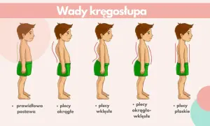 Ilustracja pokazuje wady kręgosłupa: plecy okrągłe, wklęsłe, okrągło-wklęsłe i płaskie, w porównaniu do prawidłowej postawy. Kifoza to jedna z wad.