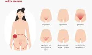 Wczesne objawy raka sromu: świąd, pieczenie, dyskomfort, zgrubienia, grudki, owrzodzenia. Zwróć uwagę na te sygnały.