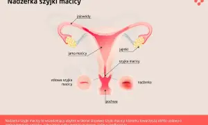 Ilustracja przedstawia budowę narządów rodnych kobiety, z zaznaczoną nadżerką szyjki macicy, która jest wrzodziejącym ubytkiem.