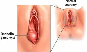 Powiększony gruczoł Bartholina, widoczny jako torbiel, obok schematu prawidłowej anatomii.