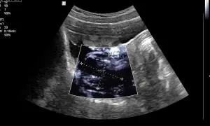 Obraz USG pokazuje torbiel jajnika z wymiarami 3.71 cm i 4.51 cm.