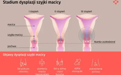 Ilustracja przedstawia stadia dysplazji szyjki macicy: I, II i III stopień, z zaznaczoną tkanką uszkodzoną w III stadium. Poniżej objawy: ból, plamienia, obfite miesiączki.