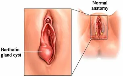 Powiększony gruczoł Bartholina, widoczny jako torbiel, obok schematu prawidłowej anatomii.
