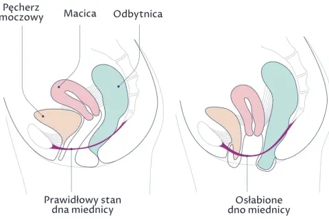 Porównanie prawidłowego i osłabionego dna miednicy. Na drugim obrazku widać obniżenie narządów, co może prowadzić do wypadania pochwy.