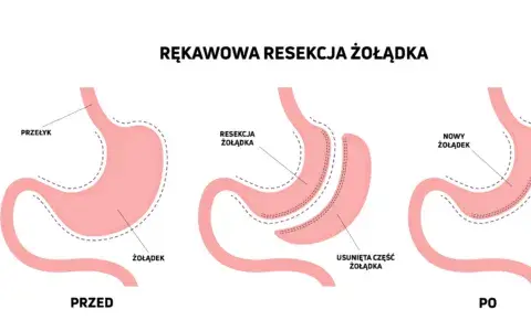 Operacja zmniejszenia żołądka na NFZ - gdzie i jak się kwalifikować