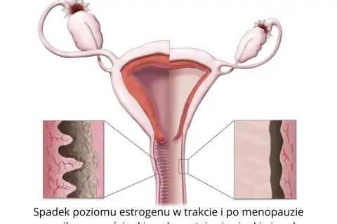 Ilustracja pokazuje, jak spadek estrogenu po menopauzie prowadzi do atrofii pochwy, powodując ścieńczenie i suchość jej ścianek.