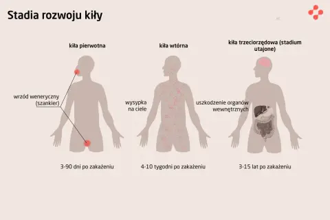 Ilustracja przedstawia stadia rozwoju kiły: pierwotne (wrzód), wtórne (wysypka) i trzeciorzędowe (uszkodzenie organów).