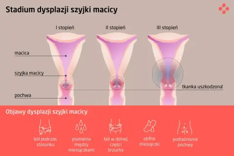 Ilustracja przedstawia stadia dysplazji szyjki macicy: I, II i III stopień, z zaznaczoną tkanką uszkodzoną w III stadium. Poniżej objawy: ból, plamienia, obfite miesiączki.
