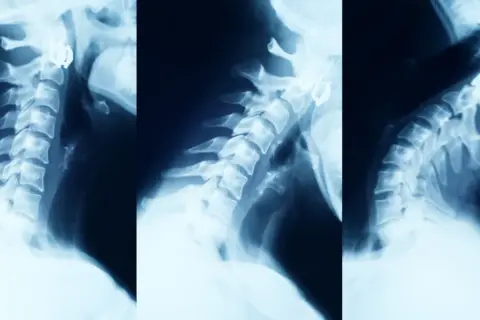 Rentgen kręgosłupa szyjnego pokazuje zmiany zwyrodnieniowe, typowe dla spondylozy. Widoczne są osteofity i zwężenia przestrzeni międzykręgowych.