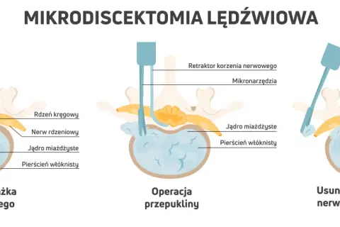 Ilustracja pokazuje etapy mikrodiscektomii lędźwiowej: przepuklina krążka międzykręgowego, operacja i usunięcie fragmentu krążka uciskającego nerw.