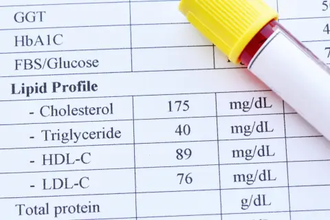 Wynik lipidogramu: cholesterol 175, triglicerydy 40, HDL-C 89, LDL-C 76. Wynik triglicerydów wskazuje na wysokie trójglicerydy.