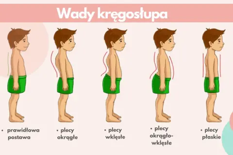 Ilustracja pokazuje wady kręgosłupa: plecy okrągłe, wklęsłe, okrągło-wklęsłe i płaskie, w porównaniu do prawidłowej postawy. Kifoza to jedna z wad.