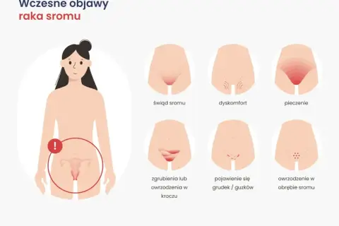 Wczesne objawy raka sromu: świąd, pieczenie, dyskomfort, zgrubienia, grudki, owrzodzenia. Zwróć uwagę na te sygnały.