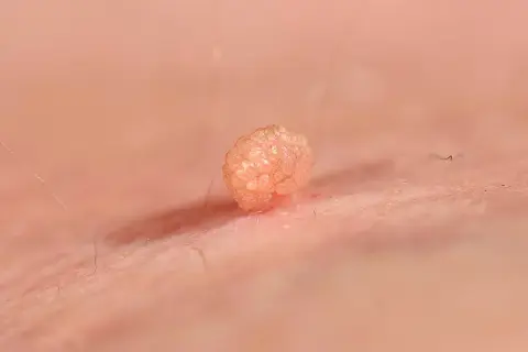 Broczawka, jeden z objawów HPV, widoczna na skórze.