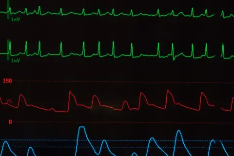 Monitor EKG pokazuje nieregularne fale, sugerujące migotanie przedsionków. Widoczne są również linie ciśnienia krwi i pulsoksymetrii.