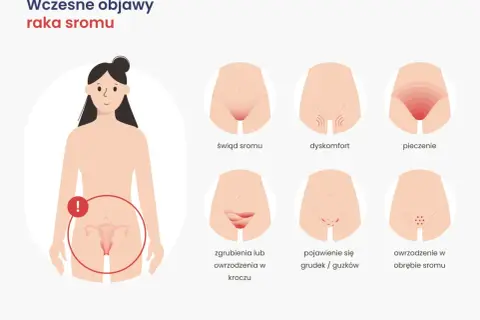 Ilustracja pokazuje wczesne objawy raka sromu: świąd, dyskomfort, pieczenie, zgrubienia, grudki i owrzodzenia.