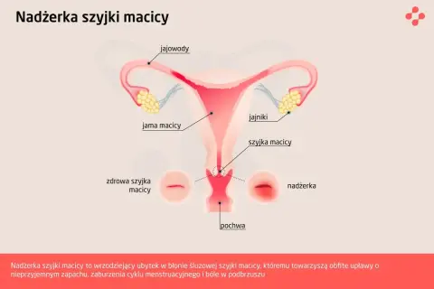 Ilustracja przedstawia budowę narządów rodnych kobiety, z zaznaczoną nadżerką szyjki macicy, która jest wrzodziejącym ubytkiem.