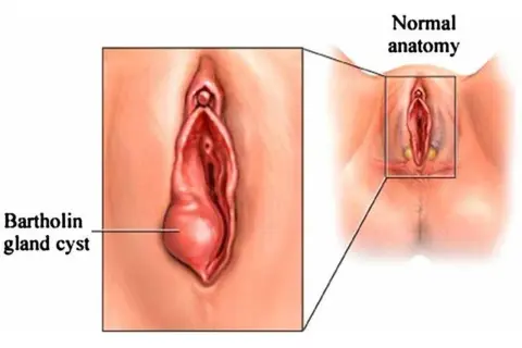Powiększony gruczoł Bartholina, widoczny jako torbiel, obok schematu prawidłowej anatomii.