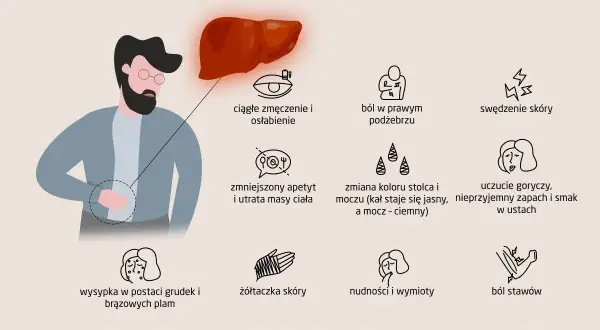 Ilustracja przedstawia objawy chorób wątroby, w tym zmęczenie, ból brzucha, swędzenie skóry, zmiany apetytu, żółtaczkę, nudności i ból stawów. Wątroba jest kluczowa dla zdrowia, a jej problemy mogą być związane z wirusem HCV.