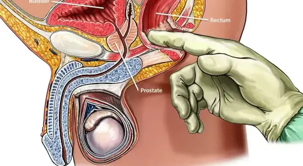 Ilustracja przedstawia badanie prostaty. Palec w rękawiczce dotyka gruczołu krokowego przez odbytnicę.