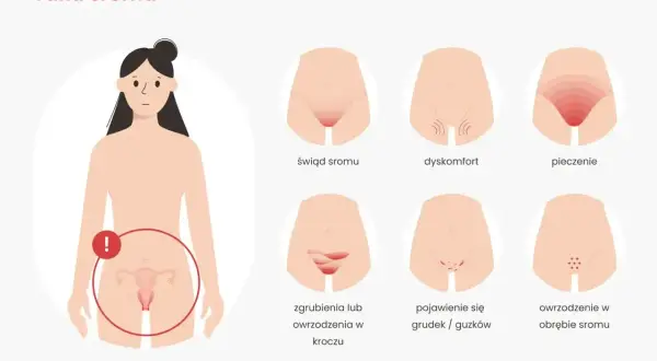 Wczesne objawy raka sromu: świąd, pieczenie, dyskomfort, zgrubienia, grudki, owrzodzenia. Zwróć uwagę na te sygnały.