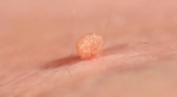 Broczawka, jeden z objawów HPV, widoczna na skórze.