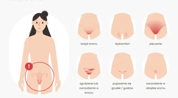 Ilustracja pokazuje wczesne objawy raka sromu: świąd, dyskomfort, pieczenie, zgrubienia, grudki i owrzodzenia.