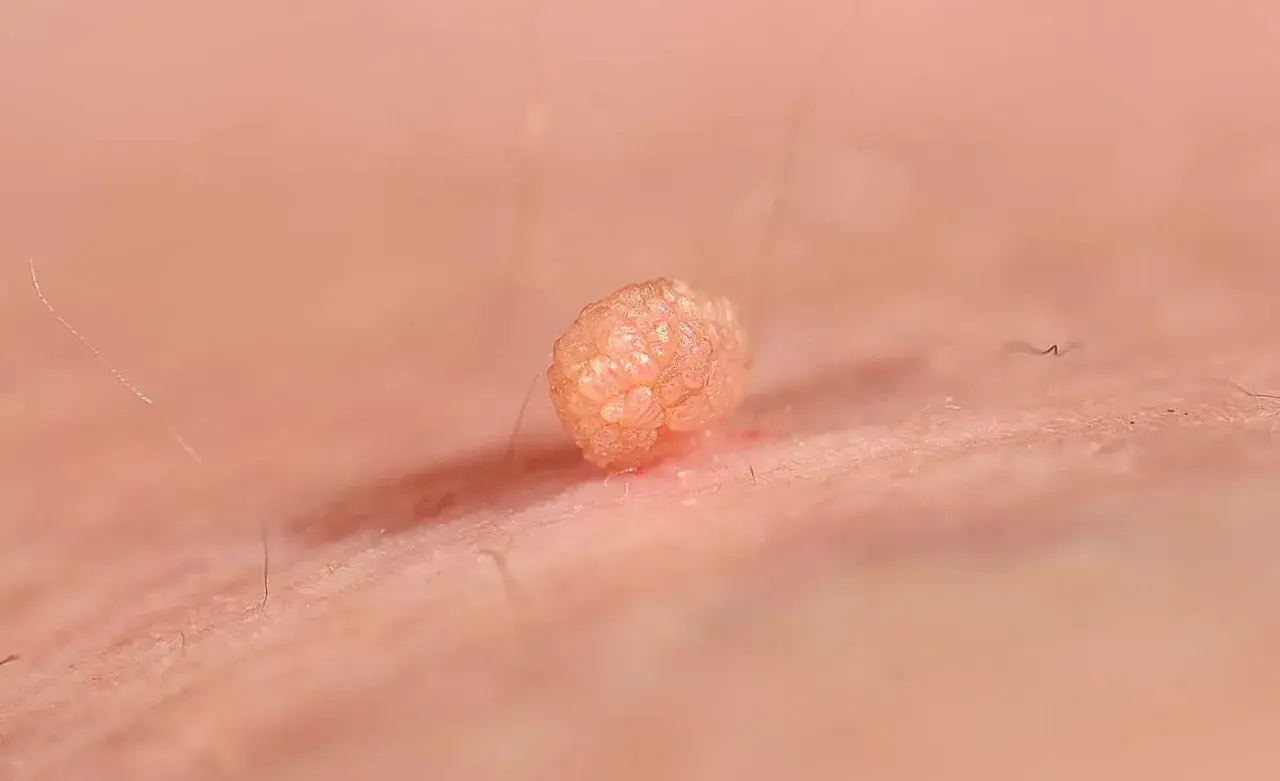 Broczawka, jeden z objawów HPV, widoczna na skórze.