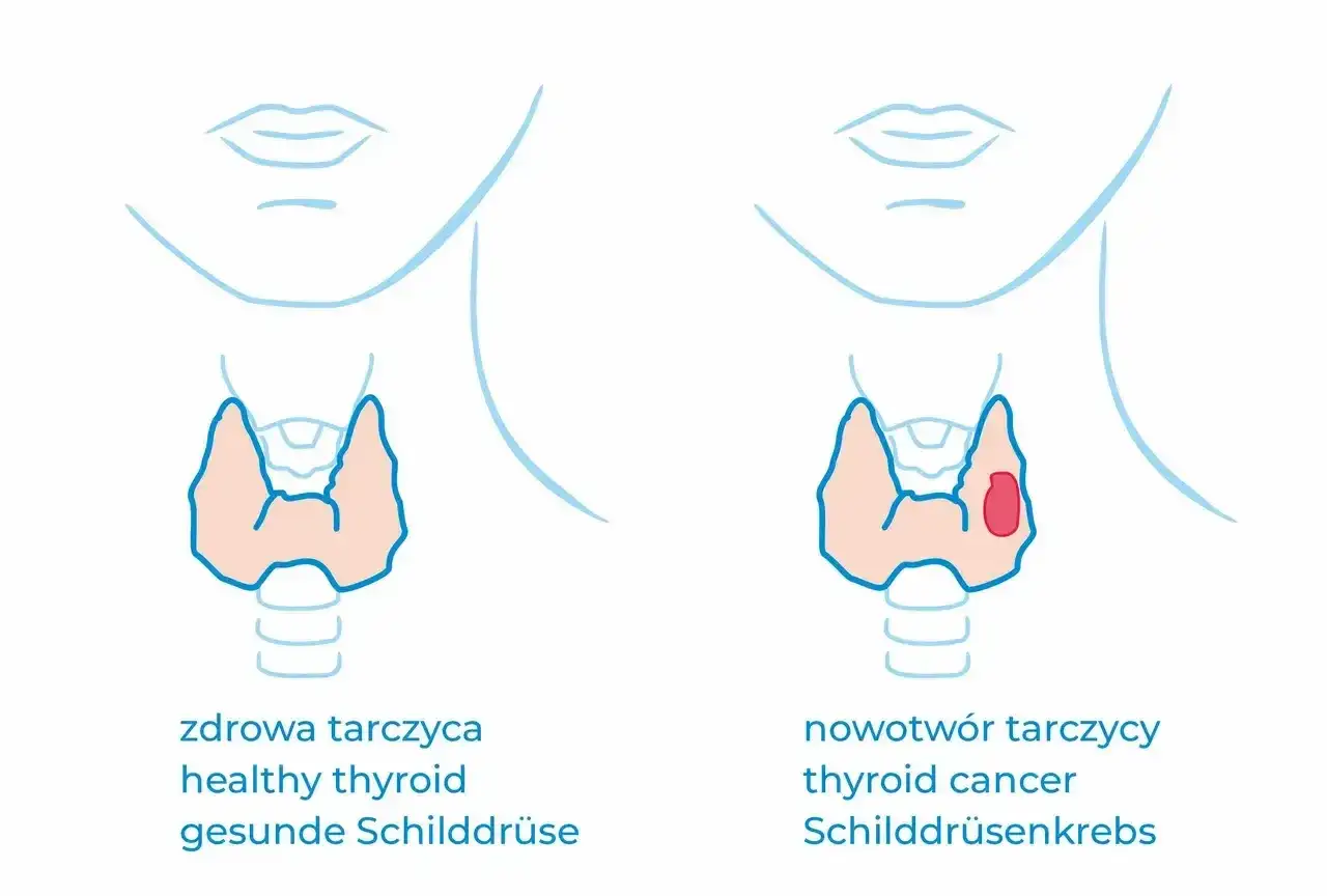 Porównanie zdrowej tarczycy z nowotworem. W zdrowej tarczycy nie widać zmian, w chorej widoczny jest guz. Kalcytonina jest markerem.