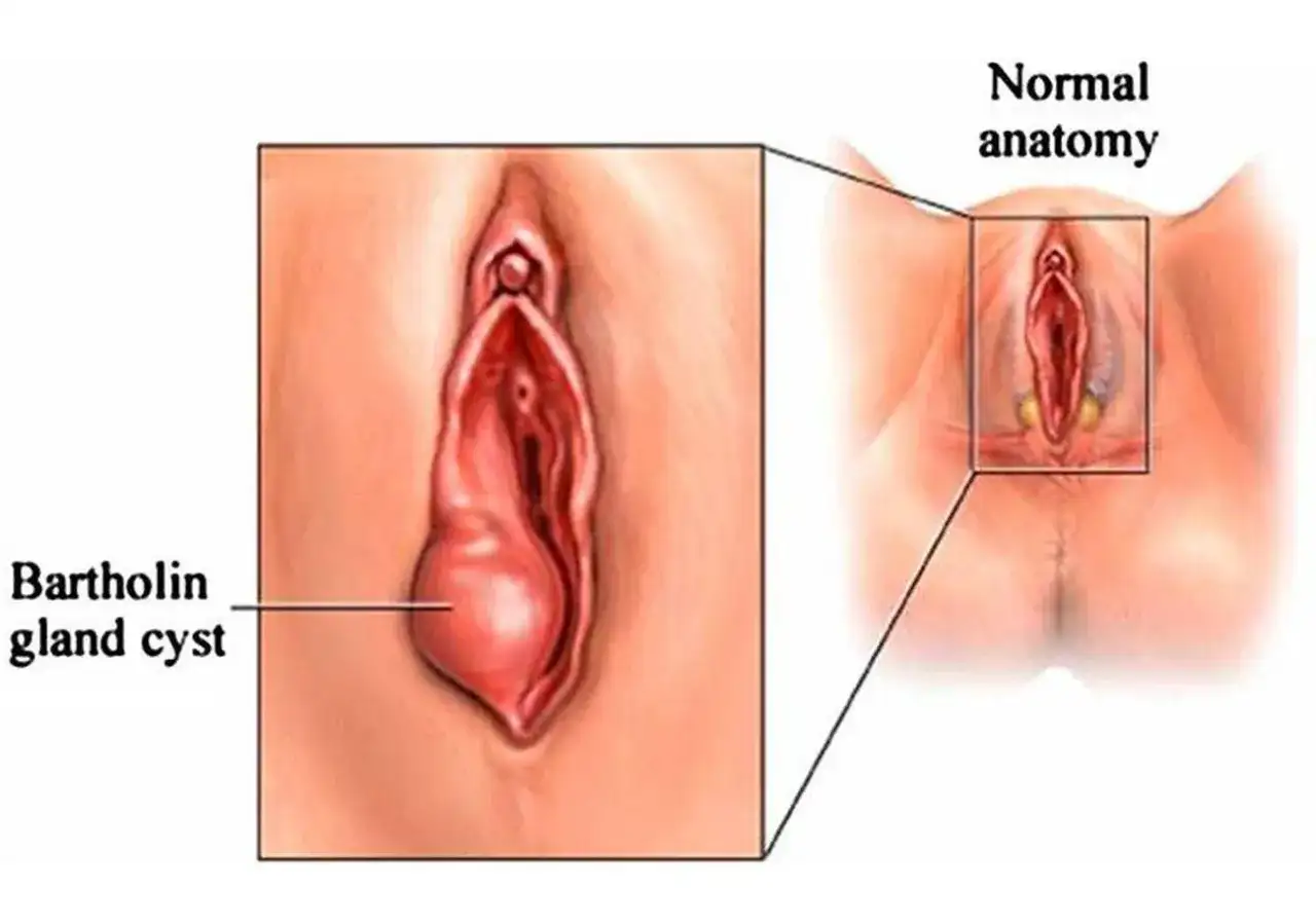 Powiększony gruczoł Bartholina, widoczny jako torbiel, obok schematu prawidłowej anatomii.