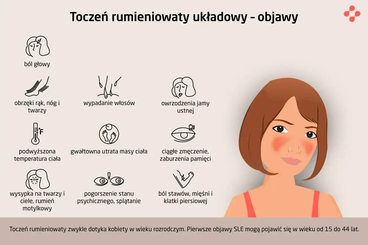 Pierwsze objawy tocznia: ból głowy, wysypka motylkowa, wypadanie włosów, owrzodzenia jamy ustnej, obrzęki, gorączka, utrata wagi, zmęczenie, problemy z pamięcią, ból stawów.