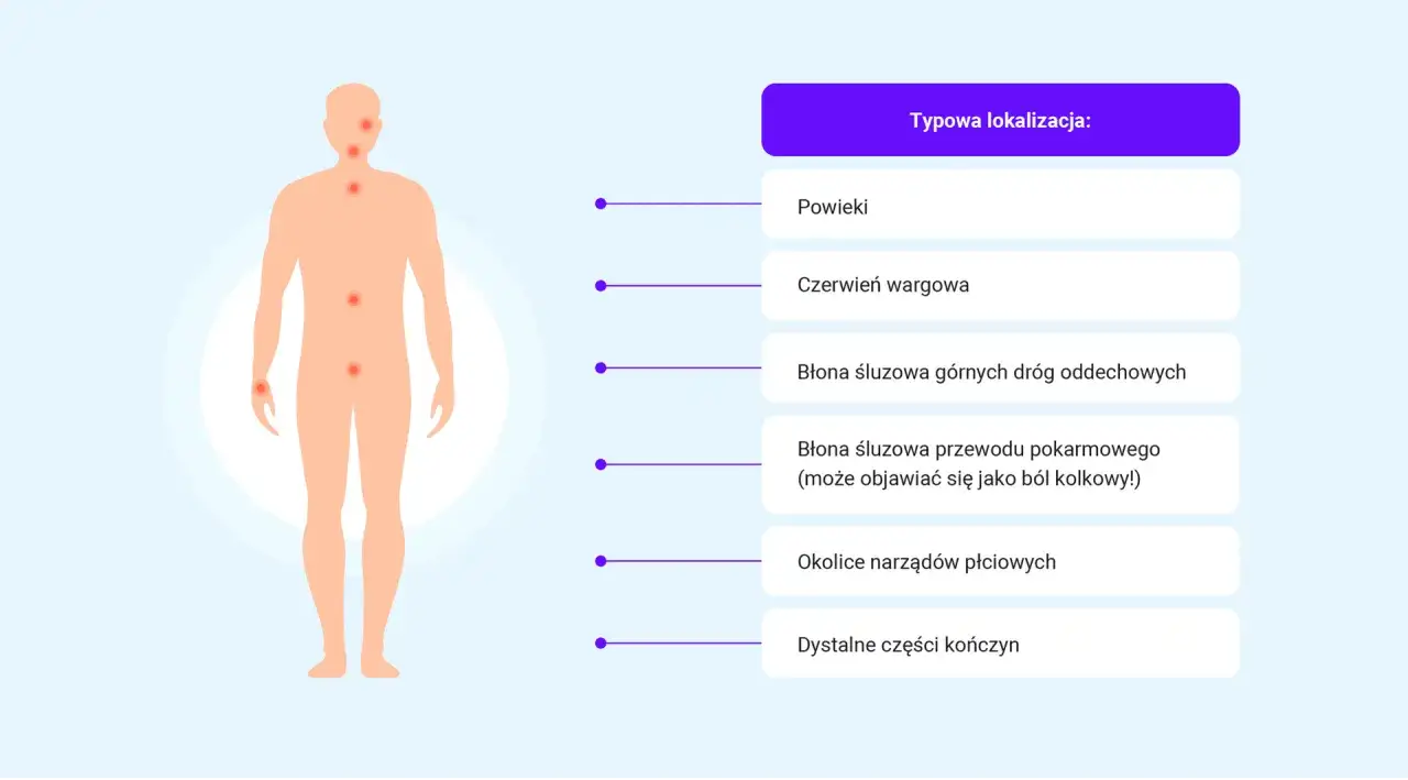 Schematyczny człowiek z zaznaczonymi miejscami występowania obrzęku: powieki, usta, drogi oddechowe, przewód pokarmowy, narządy płciowe, kończyny.