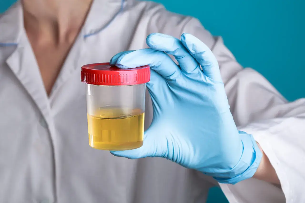 Ręka w niebieskiej rękawiczce trzyma pojemnik z żółtym płynem. To próbka moczu do badania, ważna dla diagnostyki.