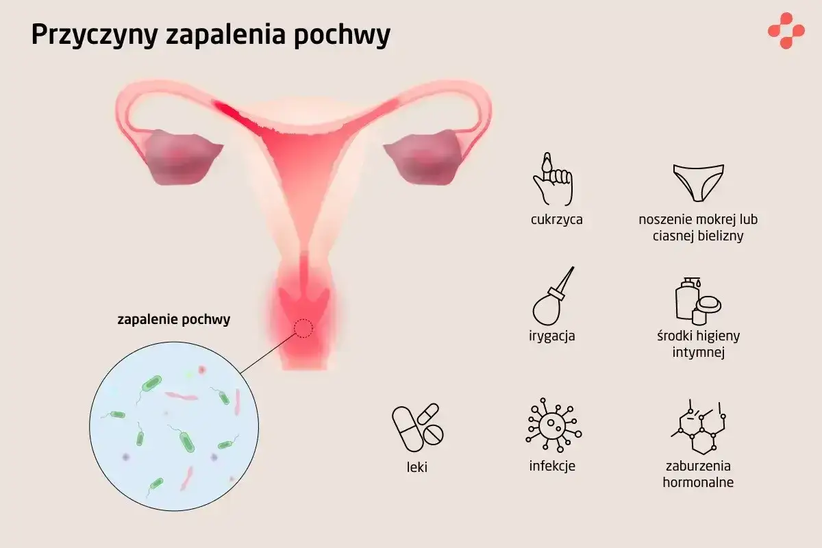 Ilustracja przedstawia przyczyny zapalenia pochwy, w tym infekcje, cukrzycę i zaburzenia hormonalne.