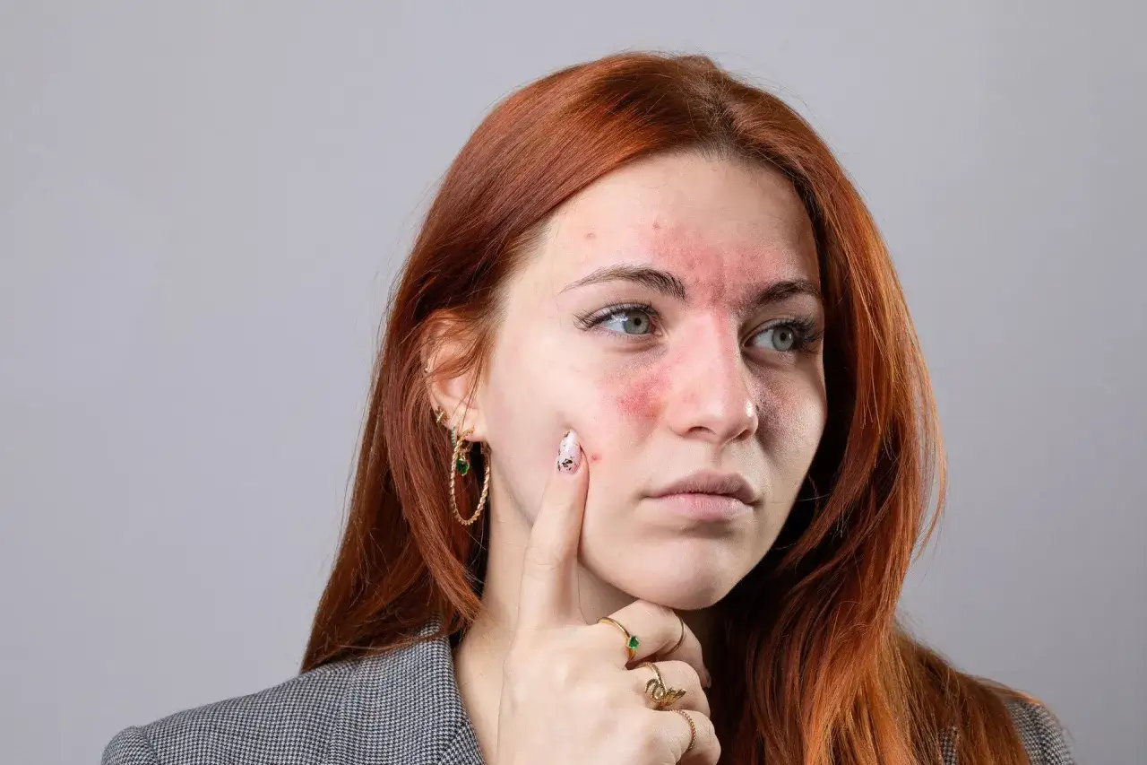 Czerwona wysypka na twarzy, szczególnie na policzkach i nosie, może być jednym z pierwszych objawów tocznia.