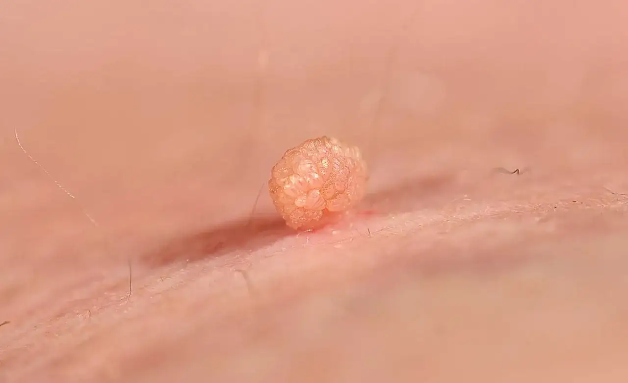 Zmiana skórna przypominająca brodawkę, jeden z objawów HPV. Może pojawić się na skórze, w tym w okolicach intymnych.