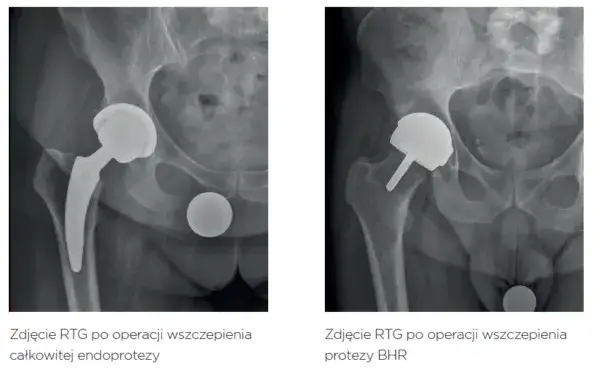 Zdjęcie Jakie endoprotezy stawu biodrowego refunduje NFZ i co warto wiedzieć