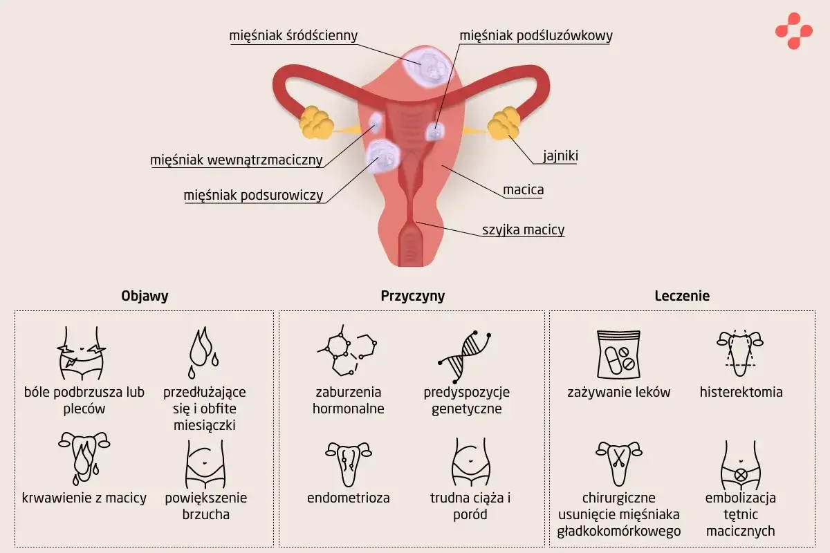 Ilustracja przedstawia budowę macicy z mięśniakami, objawy (bóle, krwawienia, powiększenie brzucha), przyczyny (zaburzenia hormonalne, genetyka) i leczenie mięśniaków macicy.