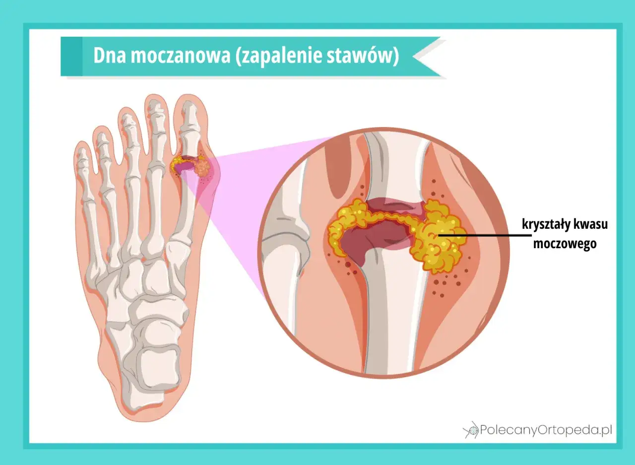 Dna moczanowa (zapalenie stawów) objawia się kryształami kwasu moczowego w stawie palucha. Leczenie jest kluczowe.
