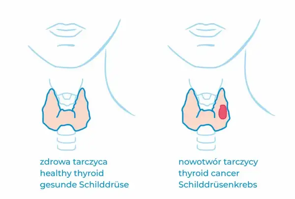 Porównanie zdrowej tarczycy z nowotworem. W zdrowej tarczycy nie widać zmian, w chorej widoczny jest guz. Kalcytonina jest markerem.