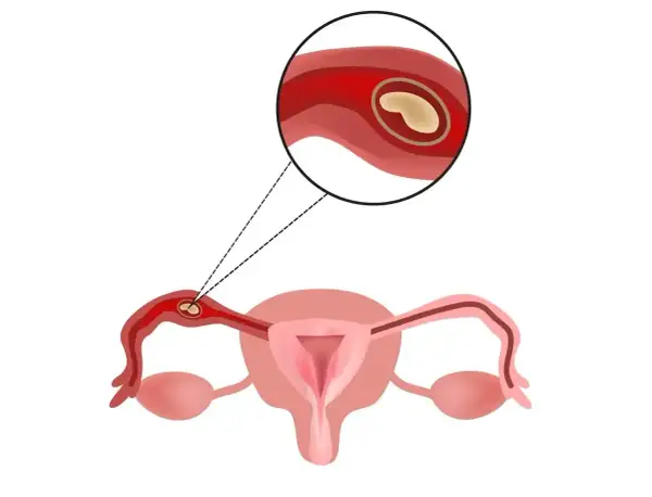 Zarys kobiecej **macicy** z powiększeniem jajowodu, gdzie widoczny jest zarodek.