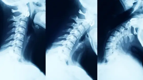Rentgen kręgosłupa szyjnego pokazuje zmiany zwyrodnieniowe, typowe dla spondylozy. Widoczne są osteofity i zwężenia przestrzeni międzykręgowych.