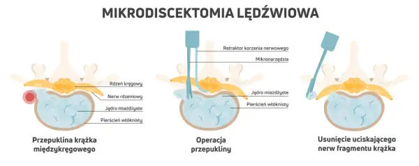 Ilustracja pokazuje etapy mikrodiscektomii lędźwiowej: przepuklina krążka międzykręgowego, operacja i usunięcie fragmentu krążka uciskającego nerw.