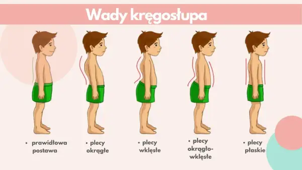 Ilustracja pokazuje wady kręgosłupa: plecy okrągłe, wklęsłe, okrągło-wklęsłe i płaskie, w porównaniu do prawidłowej postawy. Kifoza to jedna z wad.